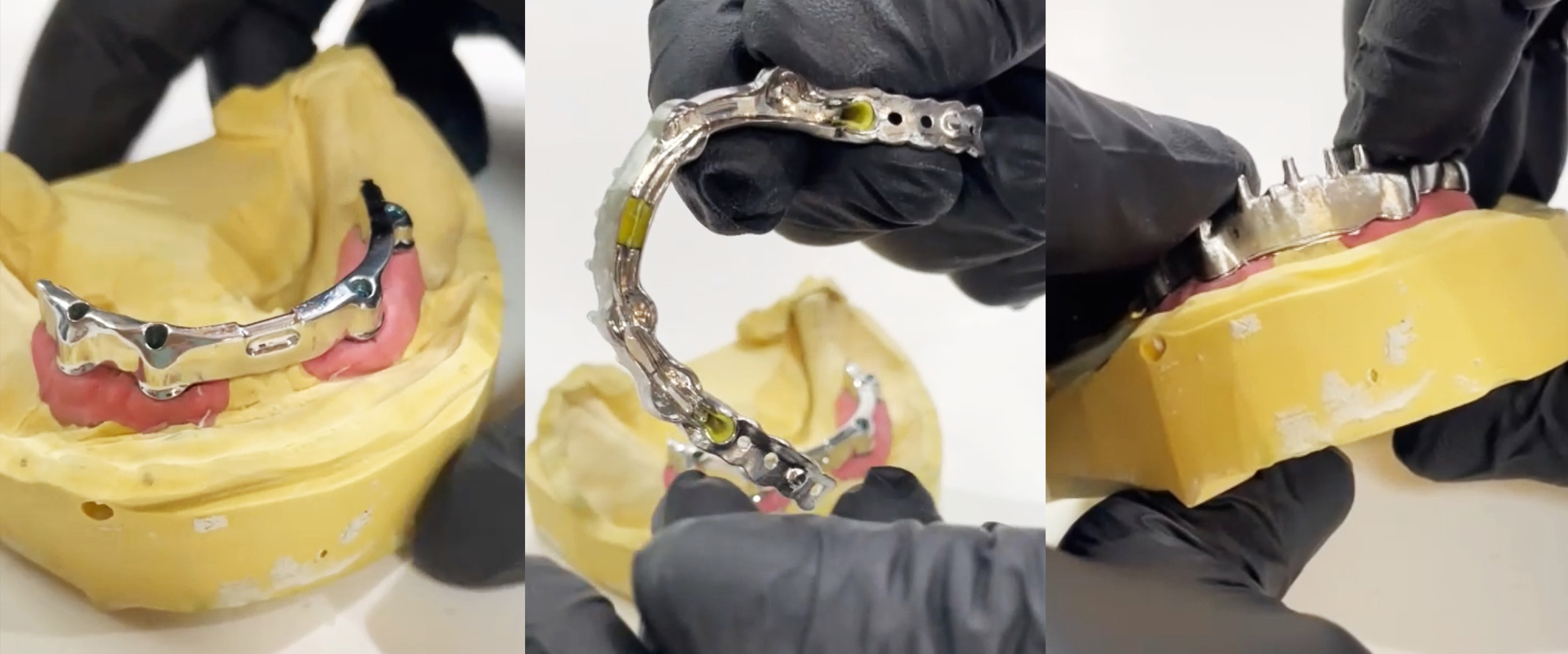 Bildvisualisierung des direktverschraubten Primärsteg auf Implantaten mit Preci Horix- und Vertix-Geschieben gefertigt und durch einen passgenauen Modellgussüberwurf als Tertiärstruktur ergänzt.