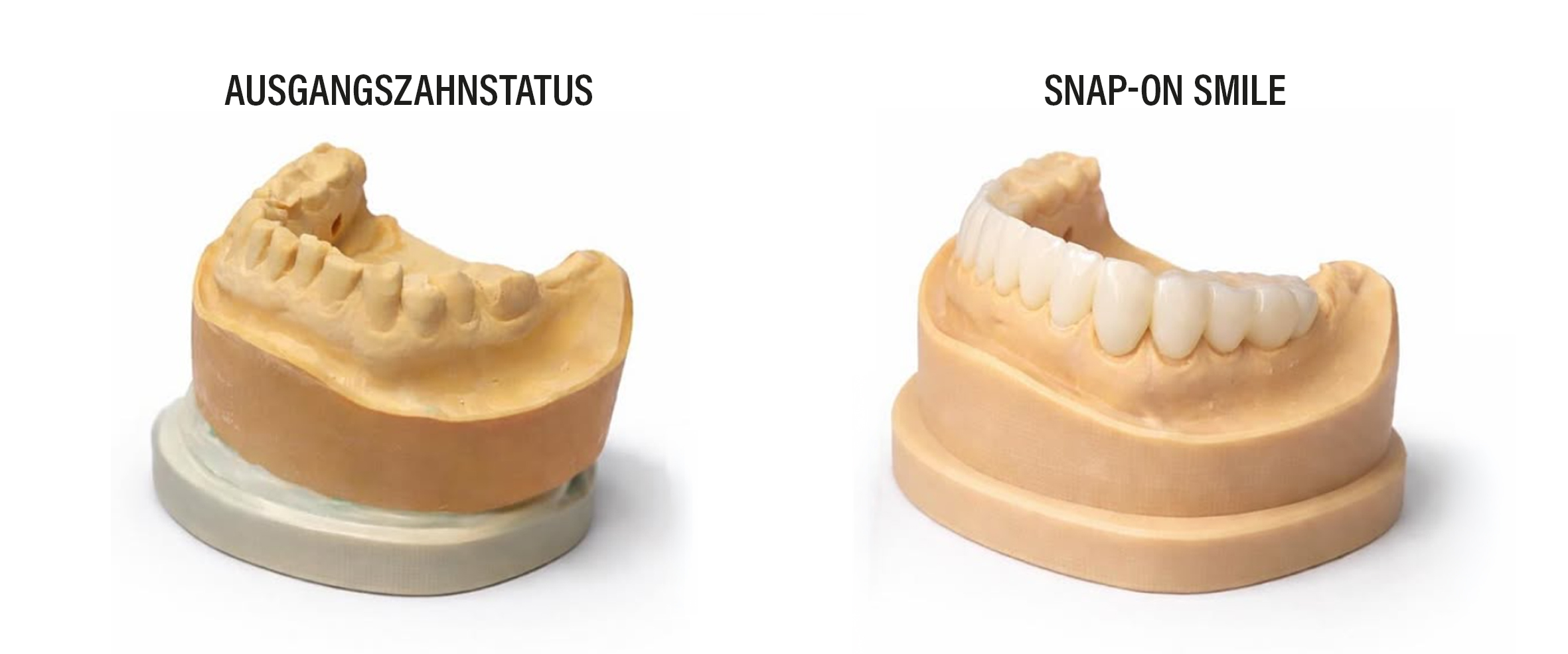 Visualisierung Vergleich Ausgangszahnstatus und mit Snap-On Smile